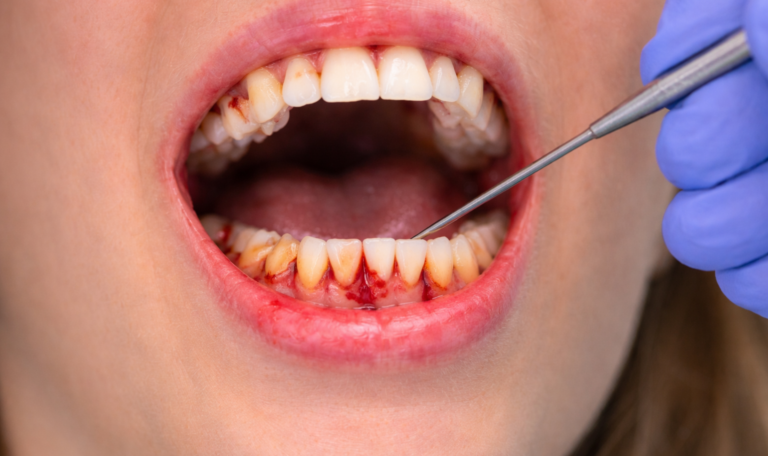 Periodontal disease